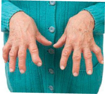 Болезни суставов рук